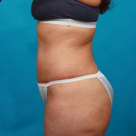 After image 3 Case #85746 - Abdominoplasty with Flank Liposuction