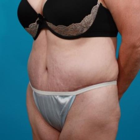 After image 2 Case #84091 - Abdominoplasty