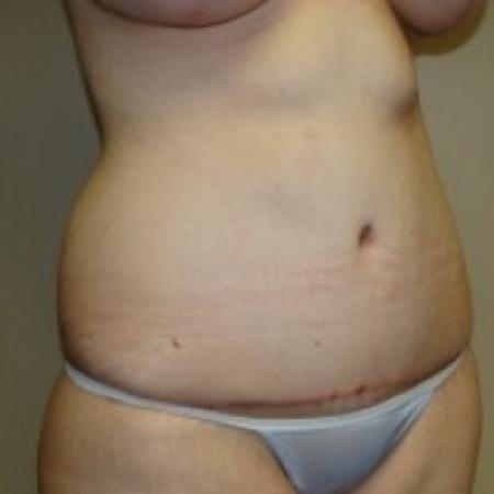 After image 2 Case #79486 - Tummy Tuck