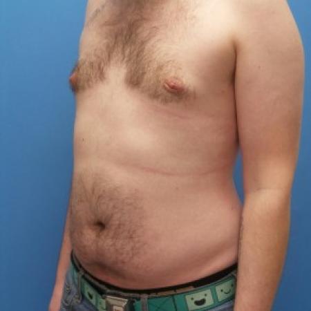 After image 2 Case #86406 - Gynecomastia