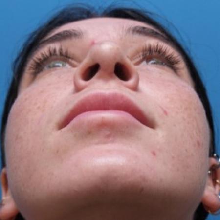 After image 4 Case #87441 - 21 year old  -  Rhinoplasty  -  6 months post-op