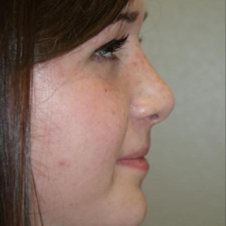 After image 2 Case #81886 - Closed Rhinoplasty