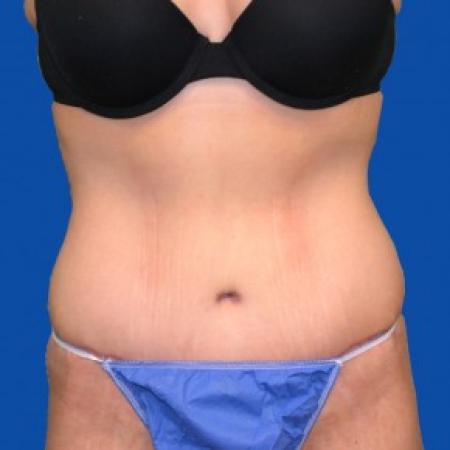 After image 1 Case #87856 - Tummy Tuck