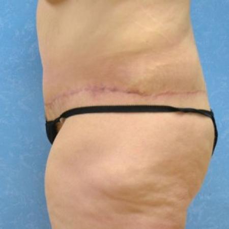 After image 1 Case #81396 - Circumferential body lift with VASER to circumferential thighs