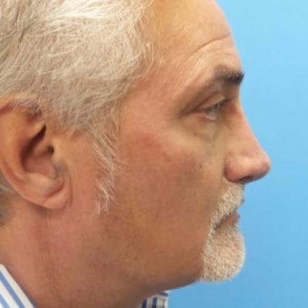 After image 3 Case #87361 - 62 year-old  -  Secondary Rhinoplasty with Cartilage Grafting  - 1 year post-op