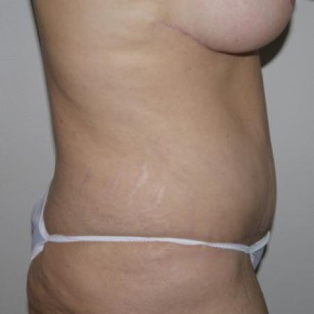 After image 2 Case #82806 - Abdominoplasty
