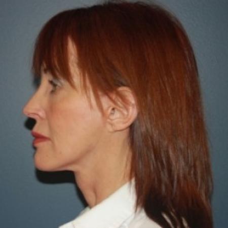 After image 3 Case #81031 - Facelift