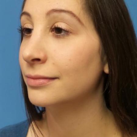 After image 2 Case #86461 - Rhinoplasty
