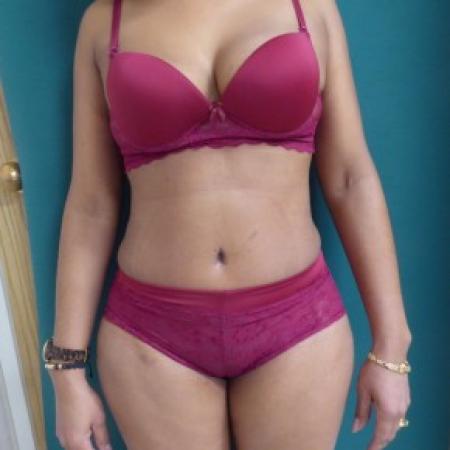 After image 1 Case #86691 - Body Contouring and Standard Abdominoplasty