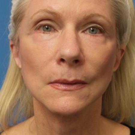 After image 1 Case #86581 - Facelift/Upper Blepharoplasty     2 months post-op