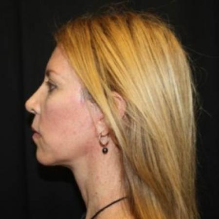 After image 3 Case #85271 - Facelift and Neck Lift - 49 year old female