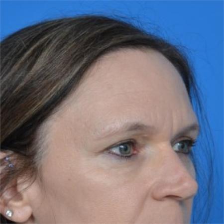 After image 2 Case #87891 - Upper Eyelid Surgery (blepharoplasty)