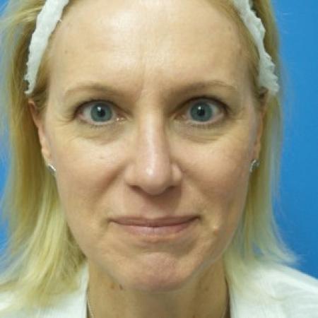 After image 1 Case #87096 - 49 year old  -  Rhinoplasty/Septoplasty/Turbinectomy  -  3 months post-op