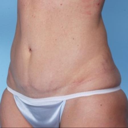 After image 2 Case #82296 - Abdominoplasty 