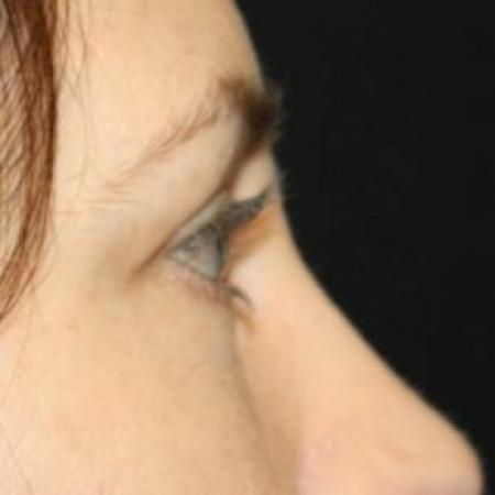 After image 3 Case #84531 - Blepharoplasty - Lower Lids Only - 41 year old female