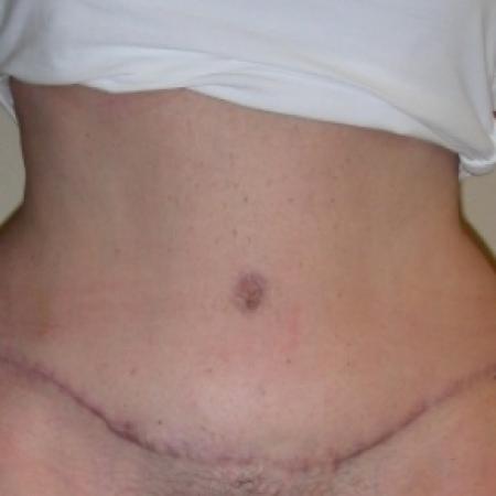 After image 1 Case #79766 - Tummy Tuck & Lipo of Love Handles