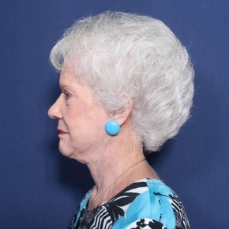After image 2 Case #83551 - 77 Years Old Female