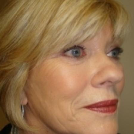 After image 2 Case #79056 - Facelift