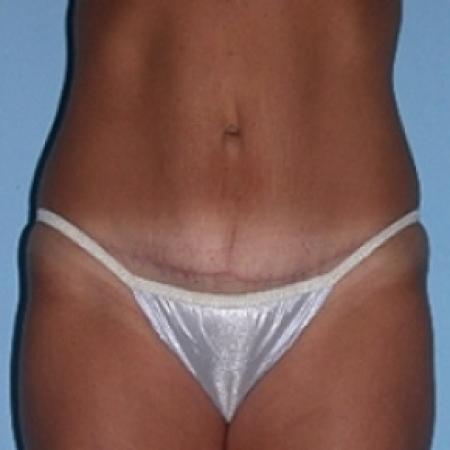 After image 1 Case #79151 - Tummy Tuck