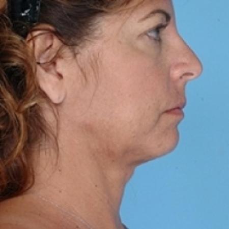 After image 2 Case #79231 - Liposuction
