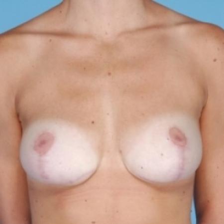After image 1 Case #79706 - Bilateral Breast Reduction 