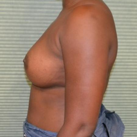 After image 3 Case #87811 - Breast Augmentation with Mentor MemoryGel smooth round 375cc high profile silicone gel filled breast implants.