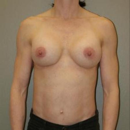 After image 1 Case #80931 - Breast Augmentation
