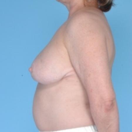 After image 3 Case #79716 - Bilateral Breast Reduction 