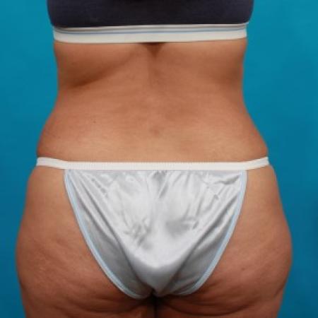 After image 5 Case #85746 - Abdominoplasty with Flank Liposuction