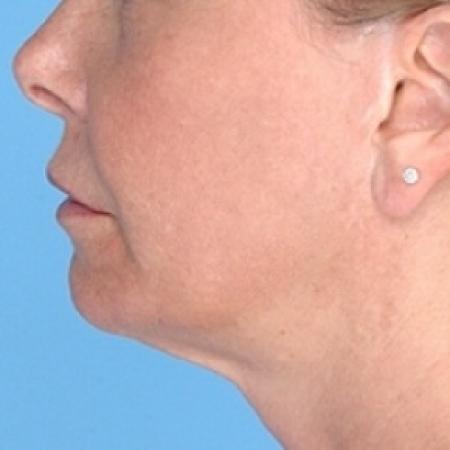 After image 2 Case #79326 - Non-Surgical Focused Ultrasound