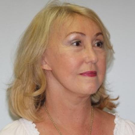 After image 2 Case #84626 - Lower facelift, necklift and browlift with SMAS grafting to Nasolabial folds