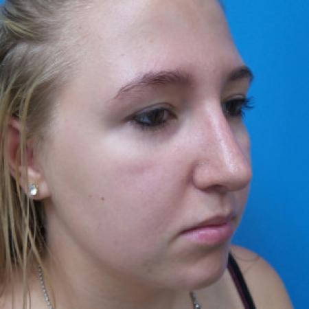 After image 2 Case #88316 - 19 year old  -  Open Rhinoplasty  -  6 months post-op