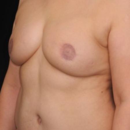 After image 2 Case #82961 - 52 y/o - Immediate DIEP Flap Breast Reconstruction