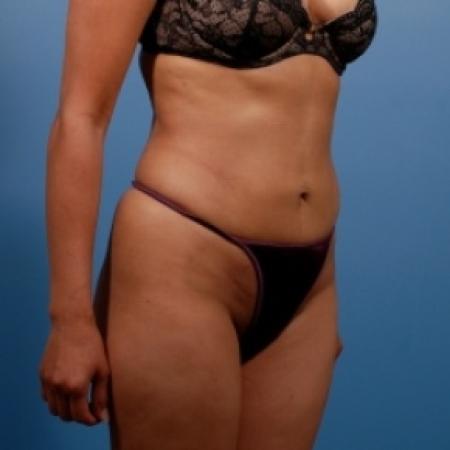 After image 2 Case #78641 - Liposuction: Abdomen & Flanks