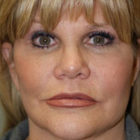 After image 1 Case #81906 - Facelift