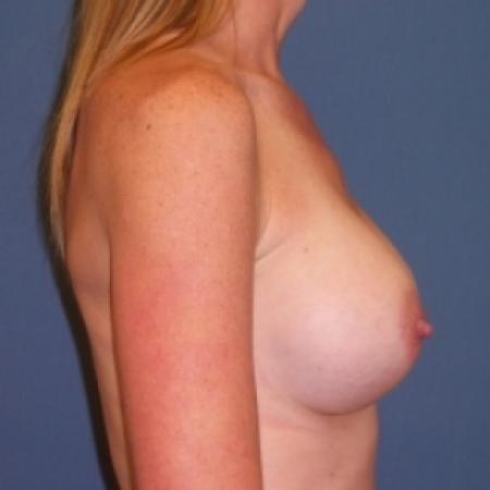 After image 3 Case #80681 - Breast Augmentation