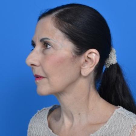 After image 4 Case #88061 - Facelift and Neck Lift