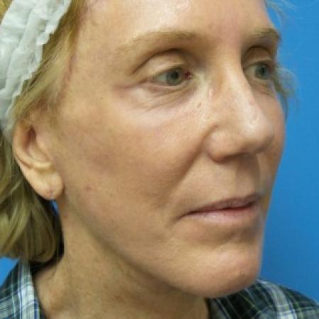 After image 2 Case #86746 - Facelift/Browlift/Laser Resurfacing to Full Face - 2 months post-op