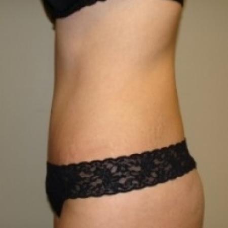 After image 3 Case #79476 - Tummy Tuck