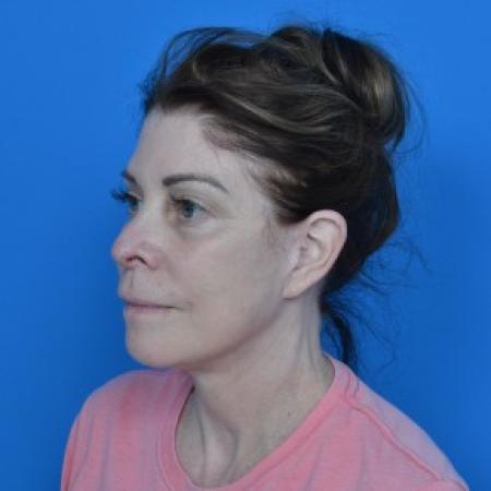 After image 2 Case #87926 - Facelift and Necklift