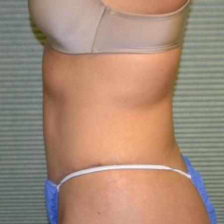 After image 3 Case #87886 - Tummy Tuck