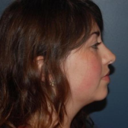 After image 2 Case #81246 - Rhinoplasty