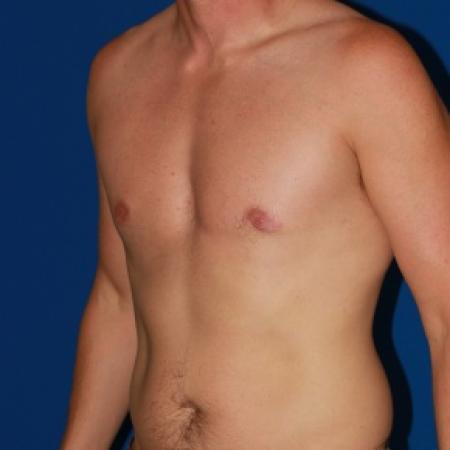 After image 2 Case #79986 - Gynecomastia male breast reduction