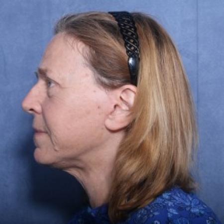 After image 2 Case #83716 - 60 Year Old Female