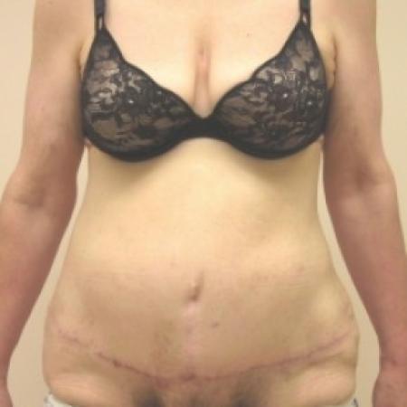 After image 1 Case #81141 - Abdominoplasty with ventral hernia repair