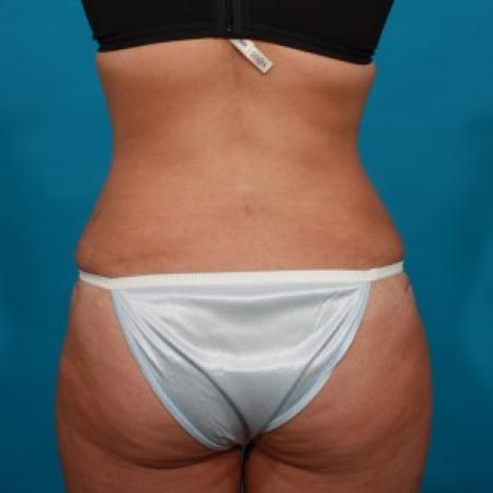 After image 5 Case #84071 - Abdominoplasty with Flank Lipo
