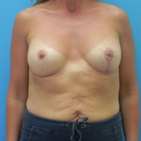 After image 1 Case #81846 - Breast Augmentation with Mastopexy (Breast Lift)