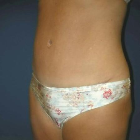 After image 2 Case #82821 - Tummy Tuck and Liposuction of Hips