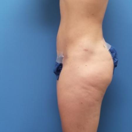 After image 2 Case #84556 - Abdominoplasty