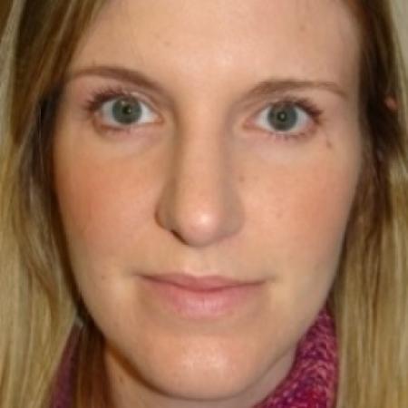 After image 1 Case #79551 - Rhinoplasty